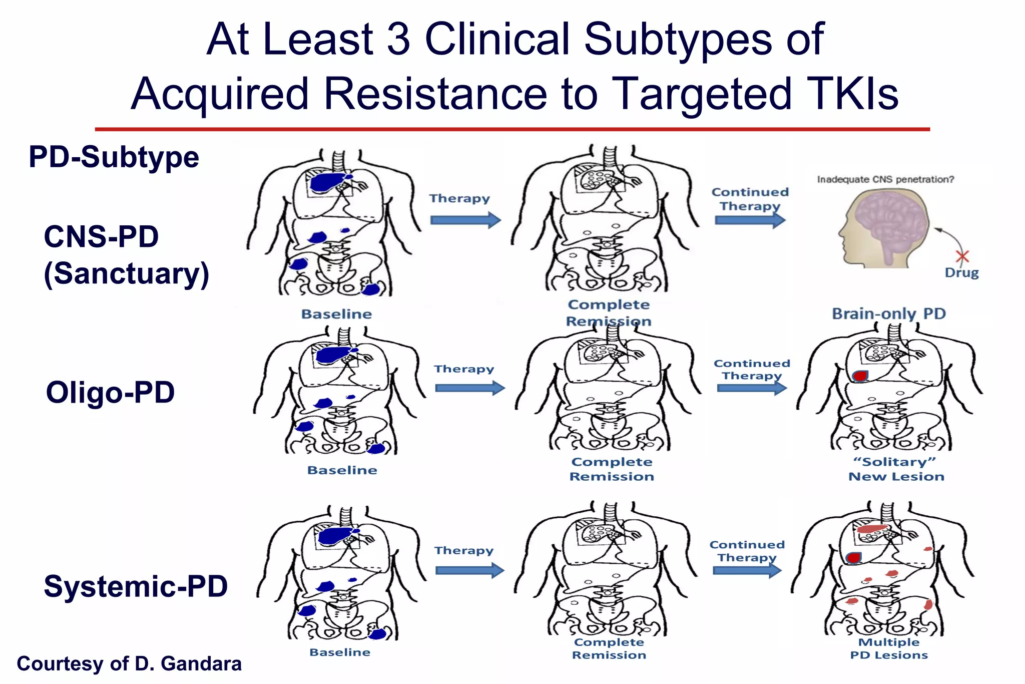 At Least 3 Clinical Subtypes of
Acquired Resistance to Targeted TKIs
PD-Subtype
CNS-PD
(Sanctuary)

Oligo-PD

Systemic-PD
Courtesy of D. Gandara

 
