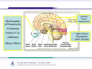 •Retinopathy
of Prematurity
•Coloboma
•Leber’s C.A.
•Albinism
•Many Others
Cortical
Visual
Impairment
• Optic Nerve
Hypoplasia
• Optic Atrophy
 