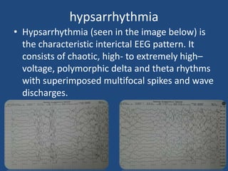 hypsarrhythmia
• Hypsarrhythmia (seen in the image below) is
  the characteristic interictal EEG pattern. It
  consists of chaotic, high- to extremely high–
  voltage, polymorphic delta and theta rhythms
  with superimposed multifocal spikes and wave
  discharges.
 