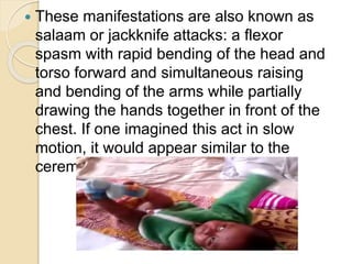  These manifestations are also known as
salaam or jackknife attacks: a flexor
spasm with rapid bending of the head and
torso forward and simultaneous raising
and bending of the arms while partially
drawing the hands together in front of the
chest. If one imagined this act in slow
motion, it would appear similar to the
ceremonial greeting (Salaam).
 