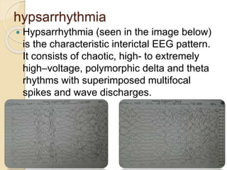 hypsarrhythmia
 Hypsarrhythmia (seen in the image below)
is the characteristic interictal EEG pattern.
It consists of chaotic, high- to extremely
high–voltage, polymorphic delta and theta
rhythms with superimposed multifocal
spikes and wave discharges.
 