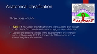 Cnv Types Wet AMD- Aug 2017 | PPTX