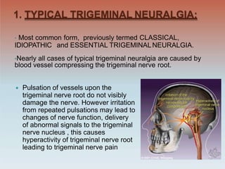1. TYPICAL TRIGEMINAL NEURALGIA:
• Most common form, previously termed CLASSICAL,
IDIOPATHIC and ESSENTIAL TRIGEMINALNEURALGIA.
•Nearly all cases of typical trigeminal neuralgia are caused by
blood vessel compressing the trigeminal nerve root.
 Pulsation of vessels upon the
trigeminal nerve root do not visibly
damage the nerve. However irritation
from repeated pulsations may lead to
changes of nerve function, delivery
of abnormal signals to the trigeminal
nerve nucleus , this causes
hyperactivity of trigeminal nerve root
leading to trigeminal nerve pain
 