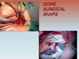 SOME
SURGICAL
SNAPS
 