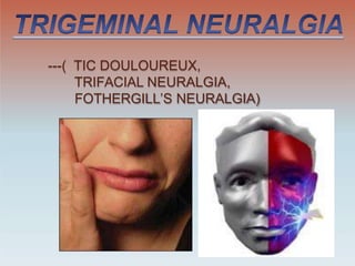 ---( TIC DOULOUREUX,
TRIFACIAL NEURALGIA,
FOTHERGILL’S NEURALGIA)
 