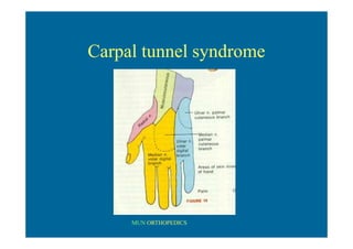 MUN ORTHOPEDICS
Carpal tunnel syndrome
 
