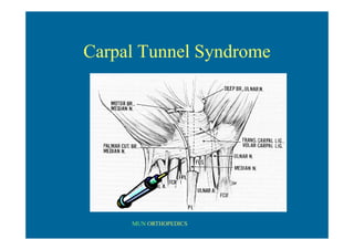 MUN ORTHOPEDICS
Carpal Tunnel Syndrome
 