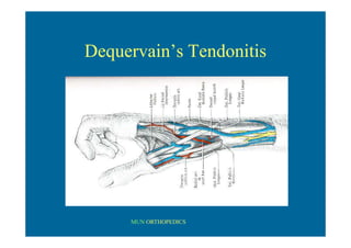 MUN ORTHOPEDICS
Dequervain’s Tendonitis
 