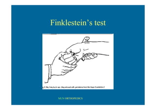 MUN ORTHOPEDICS
Finklestein’s test
 