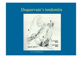 MUN ORTHOPEDICS
Dequervain’s tendonitis
 
