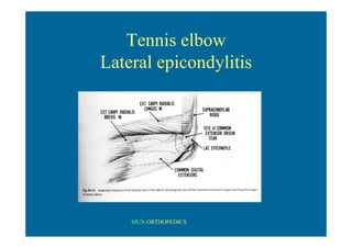 MUN ORTHOPEDICS
Tennis elbow
Lateral epicondylitis
 