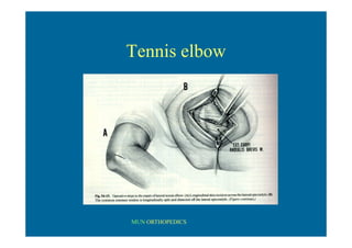 MUN ORTHOPEDICS
Tennis elbow
 