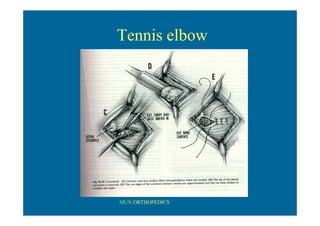 MUN ORTHOPEDICS
Tennis elbow
 