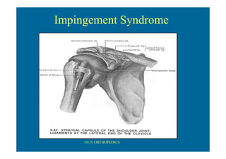 MUN ORTHOPEDICS
Impingement Syndrome
 