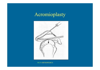MUN ORTHOPEDICS
Acromioplasty
 