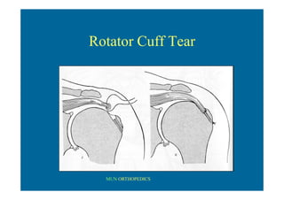 MUN ORTHOPEDICS
Rotator Cuff Tear
 