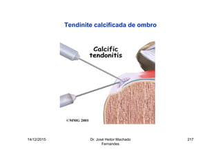 14/12/2015 Dr. José Heitor Machado
Fernandes
217
Tendinite calcificada de ombro
 