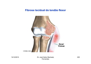 14/12/2015 Dr. José Heitor Machado
Fernandes
220
Fibrose tecidual do tendão flexor
 
