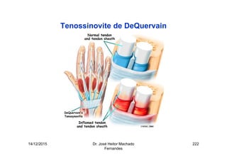 14/12/2015 Dr. José Heitor Machado
Fernandes
222
Tenossinovite de DeQuervain
 