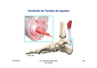 14/12/2015 Dr. José Heitor Machado
Fernandes
230
Tendinite do Tendão de Aquiles
 