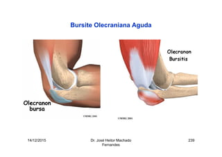 14/12/2015 Dr. José Heitor Machado
Fernandes
239
Bursite Olecraniana Aguda
 