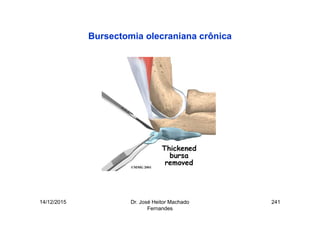 14/12/2015 Dr. José Heitor Machado
Fernandes
241
Bursectomia olecraniana crônica
 