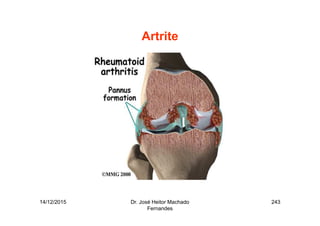 14/12/2015 Dr. José Heitor Machado
Fernandes
243
Artrite
 
