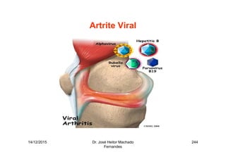 14/12/2015 Dr. José Heitor Machado
Fernandes
244
Artrite Viral
 