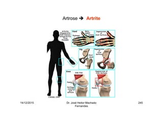14/12/2015 Dr. José Heitor Machado
Fernandes
245
Artrose Artrite
 
