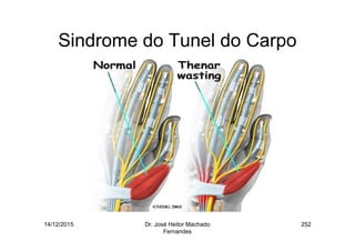 14/12/2015 Dr. José Heitor Machado
Fernandes
252
Sindrome do Tunel do Carpo
 