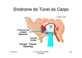 14/12/2015 Dr. José Heitor Machado
Fernandes
254
Síndrome do Túnel do Carpo
 