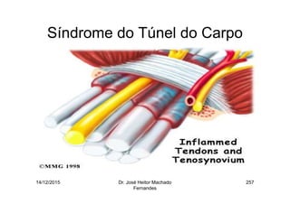 14/12/2015 Dr. José Heitor Machado
Fernandes
257
Síndrome do Túnel do Carpo
 