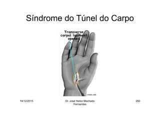 14/12/2015 Dr. José Heitor Machado
Fernandes
260
Síndrome do Túnel do Carpo
 