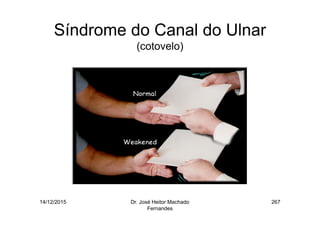 14/12/2015 Dr. José Heitor Machado
Fernandes
267
Síndrome do Canal do Ulnar
(cotovelo)
 