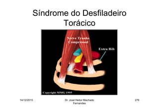 14/12/2015 Dr. José Heitor Machado
Fernandes
276
Síndrome do Desfiladeiro
Torácico
 