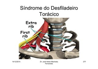 14/12/2015 Dr. José Heitor Machado
Fernandes
277
Síndrome do Desfiladeiro
Torácico
 