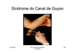 14/12/2015 Dr. José Heitor Machado
Fernandes
287
Síndrome do Canal de Guyon
 