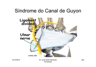 14/12/2015 Dr. José Heitor Machado
Fernandes
293
Síndrome do Canal de Guyon
 