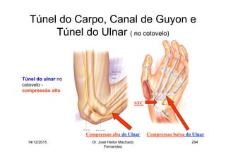 14/12/2015 Dr. José Heitor Machado
Fernandes
294
Túnel do Carpo, Canal de Guyon e
Túnel do Ulnar ( no cotovelo)
Túnel do ulnar no
cotovelo -
compressão alta
Compressao alta do Ulnar Compressao baixa do Ulnar
STC
 