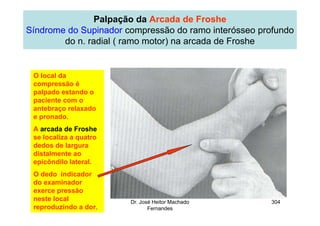 14/12/2015 Dr. José Heitor Machado
Fernandes
304
Palpação da Arcada de Froshe
Síndrome do Supinador compressão do ramo interósseo profundo
do n. radial ( ramo motor) na arcada de Froshe
O local da
compressão é
palpado estando o
paciente com o
antebraço relaxado
e pronado.
A arcada de Froshe
se localiza a quatro
dedos de largura
distalmente ao
epicôndilo lateral.
O dedo indicador
do examinador
exerce pressão
neste local
reproduzindo a dor.
 