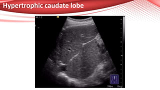 Hypertrophic caudate lobe
 
