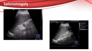 Splenomegaly
 