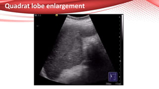Quadrat lobe enlargement
 