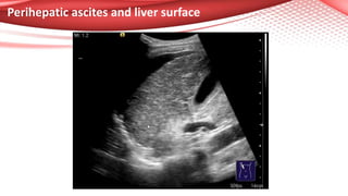 Perihepatic ascites and liver surface
 