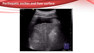 Perihepatic ascites and liver surface
 