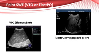 Point SWE (VTQ or ElastPQ)
VTQ (Siemens):m/s
ElastPQ (Philips): m/s or kPa
 