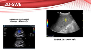 2D-SWE
SuperSonic Imagine (SSI)
(Aixplorer): kPa or m/s
2D SWE.GE: kPa or m/s
 