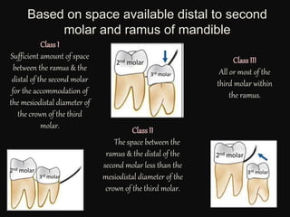Based on space available distal to second
molar and ramus of mandible
Class I
Sufficient amount of space
between the ramus & the
distal of the second molar
for the accommodation of
the mesiodistal diameter of
the crown of the third
molar.
Class II
The space between the
ramus & the distal of the
second molar less than the
mesiodistal diameter of the
crown of the third molar.
Class III
All or most of the
third molar within
the ramus.
2nd molar
3rd molar
2nd molar
3rd molar2nd molar
3rd molar
 
