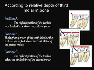 According to relative depth of third
molar in bone
Position A
The highest portion of the tooth is
on a level with or above the occlusal plane.
Position B
The highest portion of the tooth is below the
occlusal plane, but above the cervical line of
the second molar.
Position C
The highest portion of the tooth is
below the cervical line of the second molar.
3 2 1
3 2 1
3
2 1
 