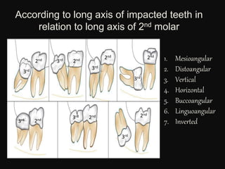 According to long axis of impacted teeth in
relation to long axis of 2nd molar
1. Mesioangular
2. Distoangular
3. Vertical
4. Horizontal
5. Buccoangular
6. Linguoangular
7. Inverted
3rd
3rd 2nd 2nd
3rd
3rd 2nd 3rd 2nd 2nd
3rd
3rd
2nd
2nd
 
